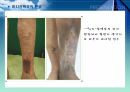 정맥류 11페이지