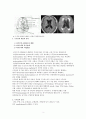 수두증 hydrocephalus 뇌수종 성인간호학 icu 중환자실 케이스 사례연구 보고서 문헌고찰 간호진단 간호사정 간호과정 비효율적 기도 청결, 감염위험성 진단 2개 5페이지