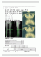 물리치료 SOAP NOTE scoliosis 척추 측만증 3페이지