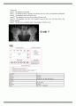 물리치료 SOAP NOTE scoliosis 척추 측만증 5페이지