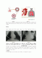 모세기간지염(bronchiolitis) 질병고찰(질병연구, 문헌고찰) 2페이지