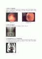 여성간호실습 자궁근종(uterine myoma), 자궁경부암(cervical cancer) 질병고찰(질병연구, 질병보고서, 문헌고찰) A+ 13페이지