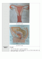 성인간호실습 수술실 case study(케이스스터디) Hysterectomy(자궁절제술) LAVH 수술과정기술 포함 A+ 14페이지