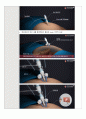 성인간호실습 수술실 case study(케이스스터디) Hysterectomy(자궁절제술) LAVH 수술과정기술 포함 A+ 15페이지