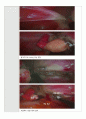 성인간호실습 수술실 case study(케이스스터디) Hysterectomy(자궁절제술) LAVH 수술과정기술 포함 A+ 17페이지