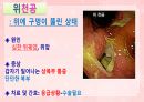 성인간호학(소화기계질환,은하출판사) 43페이지