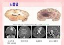 성인간호학(신경계질환,은하출판사) 15페이지