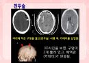 성인간호학(신경계질환,은하출판사) 21페이지