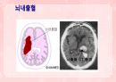 성인간호학(신경계질환,은하출판사) 24페이지