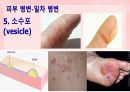 성인간호학(피부계질환,은하출판사) 15페이지