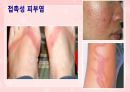 성인간호학(피부계질환,은하출판사) 33페이지