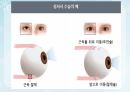 성인간호학(안과질환,은하출판사) 21페이지