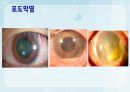 성인간호학(안과질환,은하출판사) 25페이지