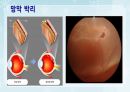 성인간호학(안과질환,은하출판사) 26페이지