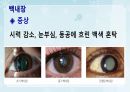 성인간호학(안과질환,은하출판사) 33페이지
