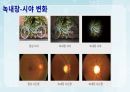 성인간호학(안과질환,은하출판사) 37페이지
