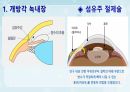 성인간호학(안과질환,은하출판사) 39페이지