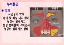 성인간호학(이비인후과질환,은하출판사) 43페이지