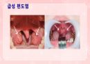 성인간호학(이비인후과질환,은하출판사) 60페이지