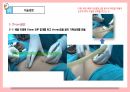 [성인간호학실습]appendectomy충수절제술 수술과정ppt발표 충수염부터 수술기구.과정.후간호까지 사진 많고 꼼꼼함 14페이지