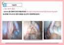 [성인간호학실습]appendectomy충수절제술 수술과정ppt발표 충수염부터 수술기구.과정.후간호까지 사진 많고 꼼꼼함 17페이지