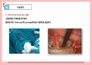 [성인간호학실습]appendectomy충수절제술 수술과정ppt발표 충수염부터 수술기구.과정.후간호까지 사진 많고 꼼꼼함 19페이지