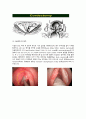 진단명-Glottic ca(후두암), 수술명 - Laser cordectomy(레이저 성대절제술) 3페이지