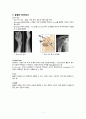 [성인간호실습 A+] ORIF, 대퇴골 골절 폐쇄성 케이스, 간호진단 급성통증, 감염의 위험, 피부 통합성 장애 7페이지