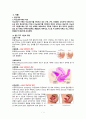 모성간호학 자궁하수(Uterine prolapse) 3페이지