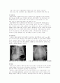 신생아실 실습케이스 NICU A+ 아주 자세한 병태생리 및 간호사정, 간호진단 2개 4페이지