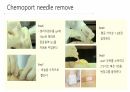 케모포트(Chemoport) 간호 8페이지