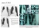 각종배액관관리(헤모박,체스트튜브,PCD,Paracentesis,Ostomy) 34페이지