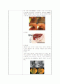 성인간호학실습I 케이스 과제 CBD stone 24페이지