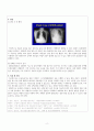 아동간호학실습 NICU(신생아중환자실) 케이스 - 급성호흡곤란증후군(ARDS) 간호진단 5개+간호과정 2개 (A+) 2페이지