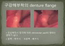 세미나자료 구강해부학의 총의치(덴쳐) 제작(치의학, 치기공, 치위생) 19페이지