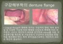 세미나자료 구강해부학의 총의치(덴쳐) 제작(치의학, 치기공, 치위생) 22페이지
