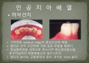 세미나자료 구강해부학의 총의치(덴쳐) 제작(치의학, 치기공, 치위생) 56페이지