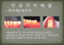세미나자료 구강해부학의 총의치(덴쳐) 제작(치의학, 치기공, 치위생) 64페이지