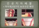 세미나자료 구강해부학의 총의치(덴쳐) 제작(치의학, 치기공, 치위생) 65페이지