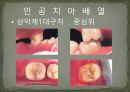 세미나자료 구강해부학의 총의치(덴쳐) 제작(치의학, 치기공, 치위생) 67페이지