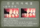 세미나자료 구강해부학의 총의치(덴쳐) 제작(치의학, 치기공, 치위생) 77페이지