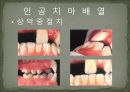 세미나자료 구강해부학의 총의치(덴쳐) 제작(치의학, 치기공, 치위생) 78페이지