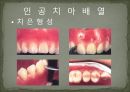 세미나자료 구강해부학의 총의치(덴쳐) 제작(치의학, 치기공, 치위생) 80페이지