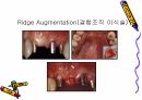 세미나자료 세라믹을 위한  치주조직과 색조 3D-Master Shade Taking 15페이지