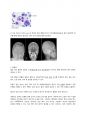 다발성 골수종 MM Multiple myeloma 레포트/ 항암 화학요법 3페이지