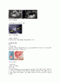 A+ 자료 ) 포상기태, 자궁경관무력증  문헌고찰,  간호과정 1개 ( 수술과 관련된 급성통증 ) 15페이지