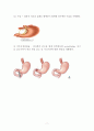 성인건강간호학 / 위궤양 / gastric ulcer / 진단5 과정2 중재21 9페이지