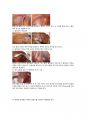 탈장 hernia 수술실 케이스 8페이지
