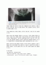 화농성 관절염(pyogenic arthritis) 환자의 치료 및 간호 5페이지