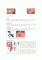cervical dysplasia(자궁경부이형성증) 케이스 19페이지